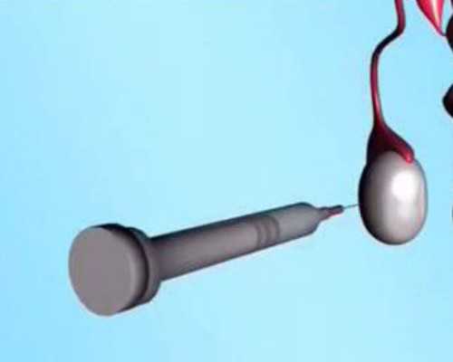 三代试管婴儿的优点和缺点是什么？