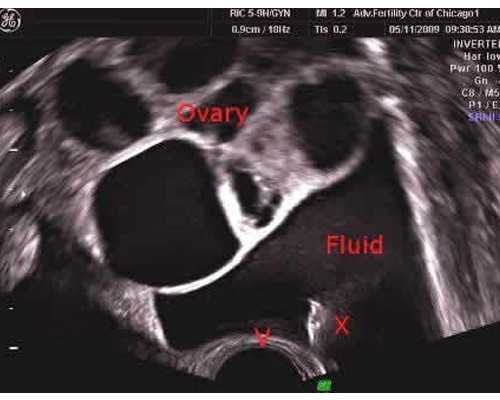 取卵后可以吃巧克力？取卵后吃巧克力好不好？