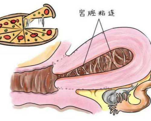 三代试管婴儿怎么选性别？一分钟告诉你