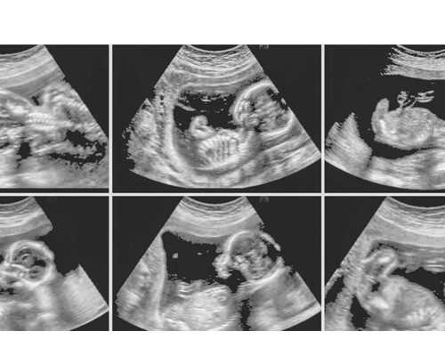 在苏州市立医院做三代试管可以移植两个胚胎生双胎吗？