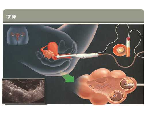 美国试管婴儿男性不育的原因有哪些？