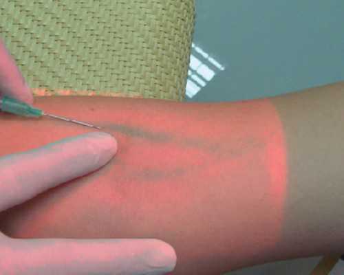 女性赴美试管婴儿如何选择促排卵方案？