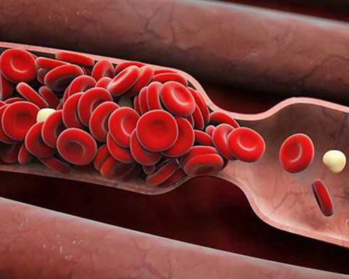 孕妇中暑可以拔罐吗孕妇中暑该怎么办