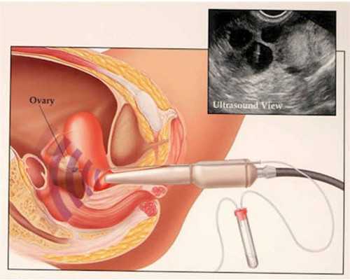 做试管子宫内膜c型怎么调理