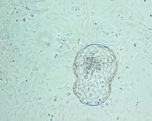 卵巢妊娠hcg会翻倍吗